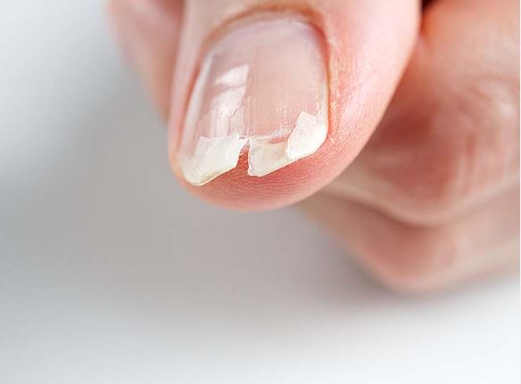 ongle-fendu-verticalemen-causes