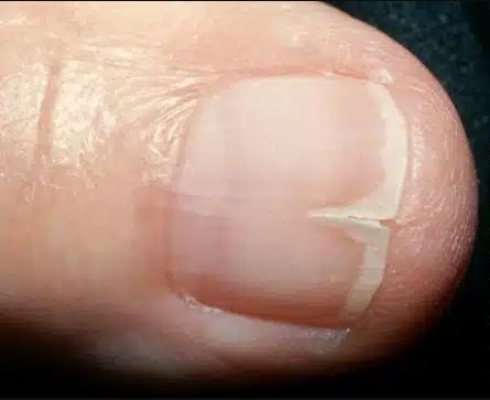 ongle-fendu-verticalement